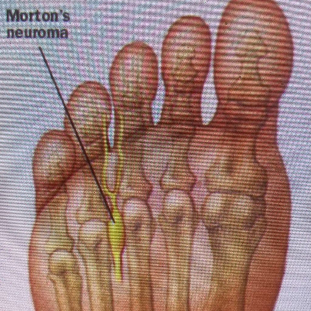 Névrome de Morton - Dr Fabien Ros, chirurgien orthopédique à Aubagne